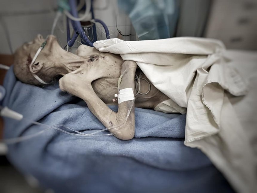 В Днепре умерла пациентка, у которой от голода атрофировались мышцы