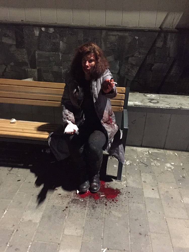 В Киеве женщине сломали нос и выбили зубы из-за русского языка