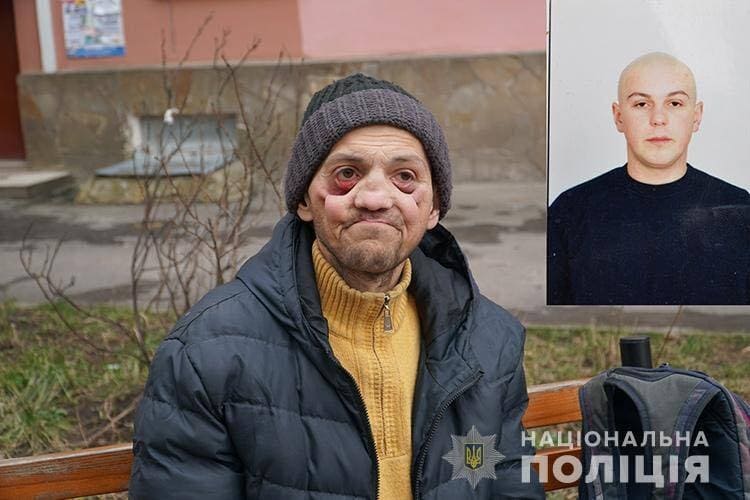 Амфетамін "з'їв" молодого українця за 2 роки: зуби випали, щелепа згнила. Фото