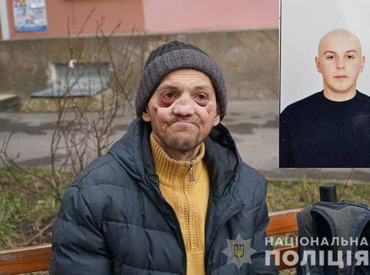 Амфетамін "з'їв" молодого українця за 2 роки: зуби випали, щелепа згнила. Фото